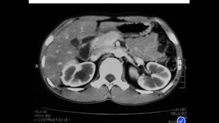 aKI with Low potassium and paralysis , 