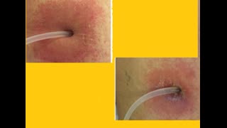 39 YEAR old PD patient with exit site skin RASH 
