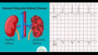PKD patient with A fib episode