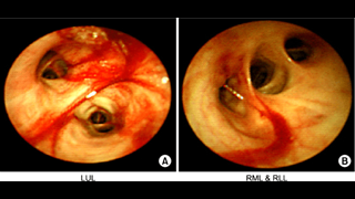 Bronchoscopic-findings-Bronchoscope-shows-mucosal-edema-flush-bleeding-in-left-upper