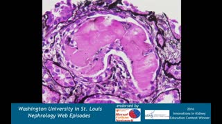 Web Episode #022 - Renal Pathology Teaching Series - Myeloma Cast Nephropathy